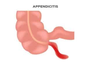 Appendix Surgery