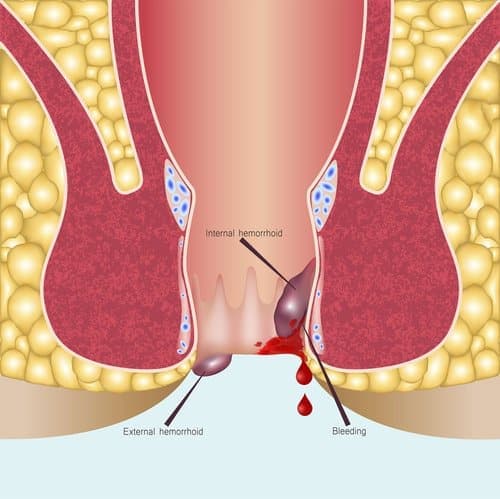 Hemorrhoids Surgery