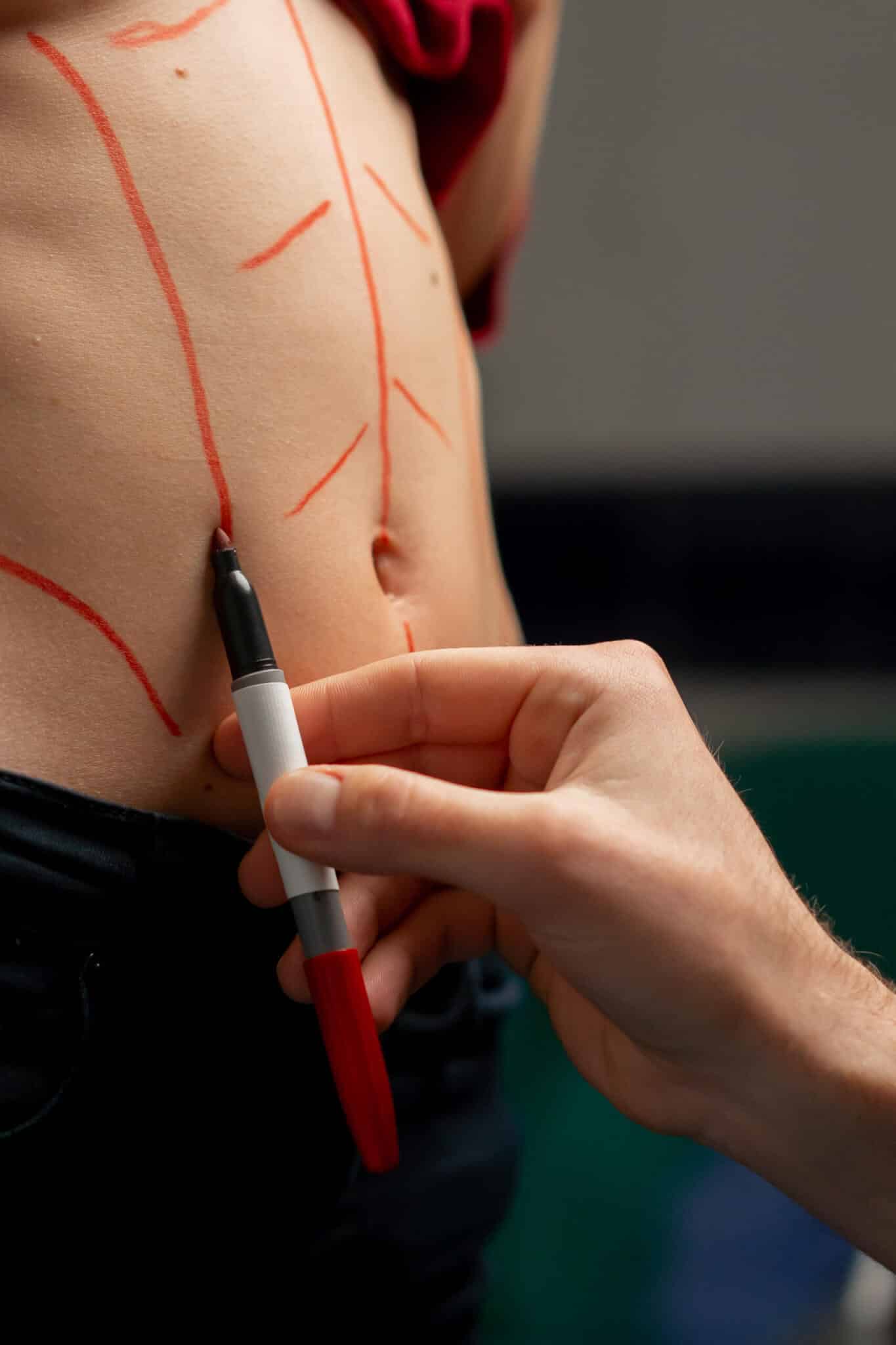 Liposuction