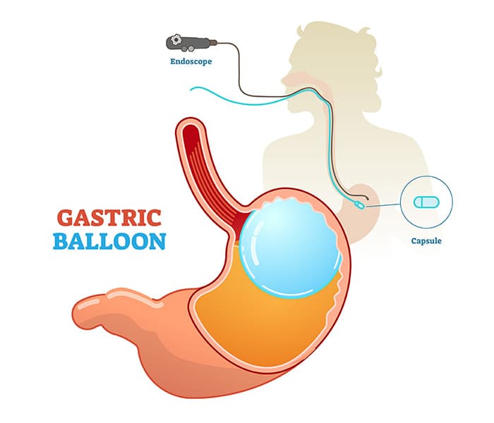 Gastric Balloon Insertion and Removal