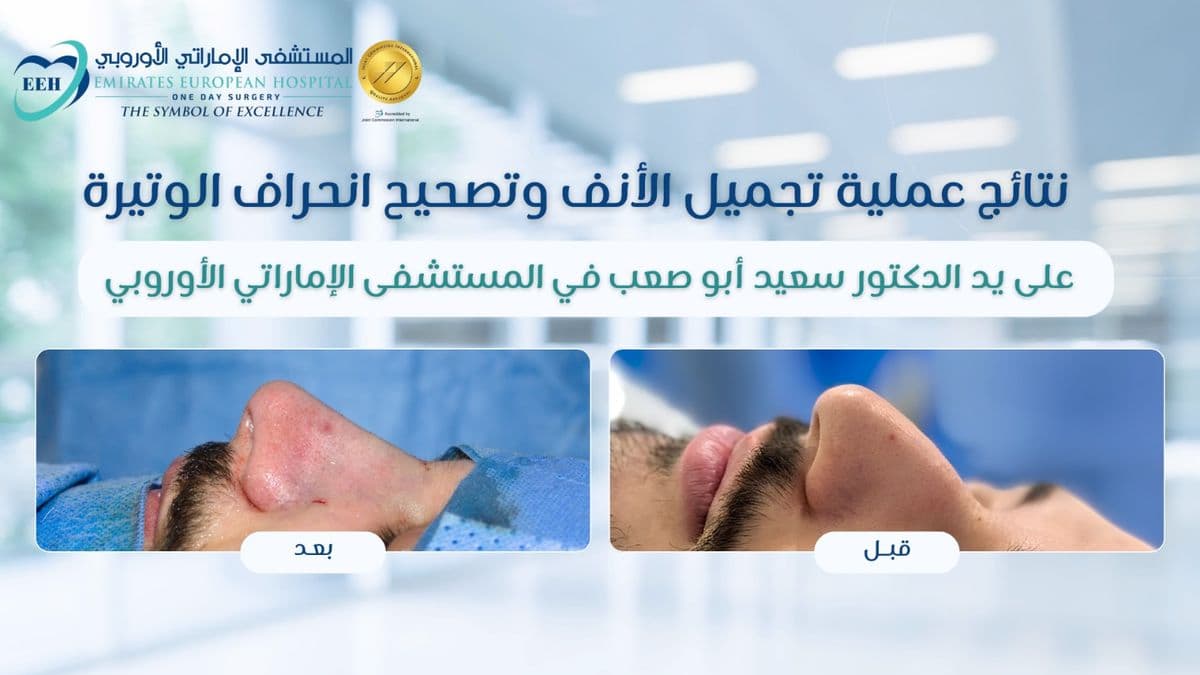 Rhinoplasty in Sharjah