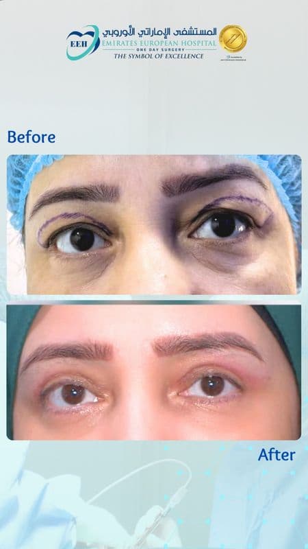 Eyelid Surgery - Case 2 | Emirates European Hospital