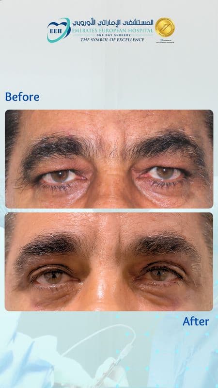 Eyelid Surgery - Case 3 | Emirates European Hospital