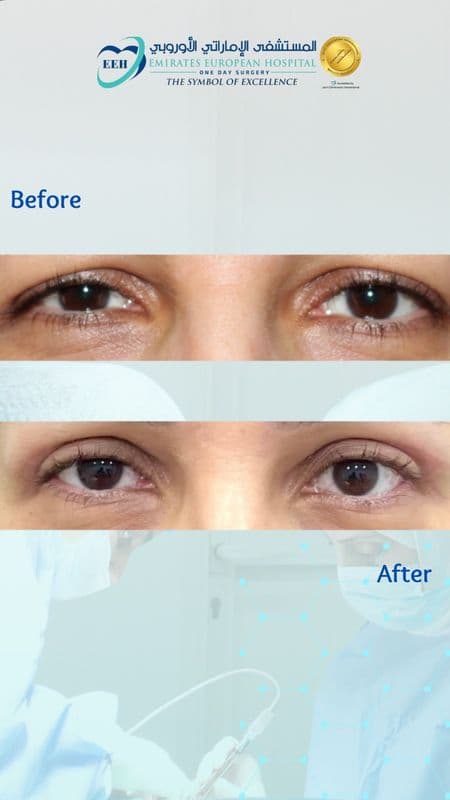 Eyelid Surgery - Case 4 | Emirates European Hospital