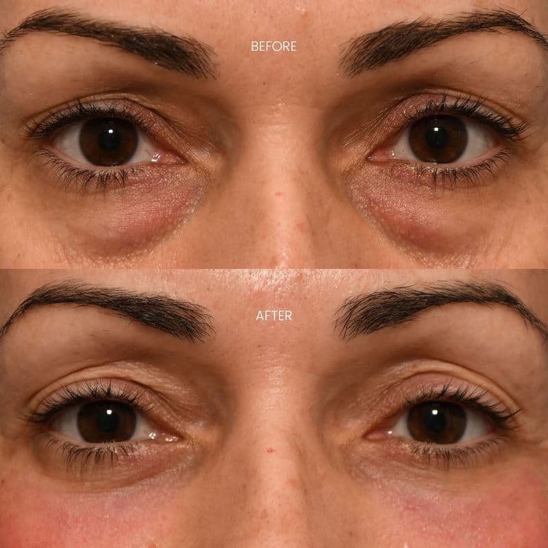 Eyelid Surgery - Case 5 | Emirates European Hospital