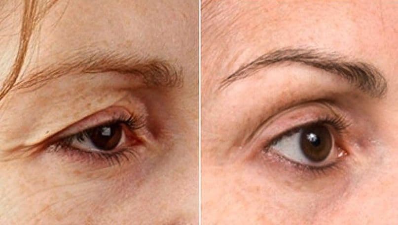 Eyelid Surgery - Case 6 | Emirates European Hospital