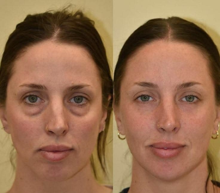 Eyelid Surgery - Case 7 | Emirates European Hospital