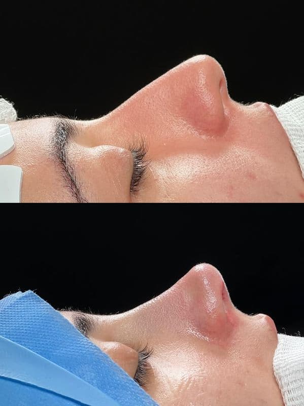 Rhinoplasty - Case 4 | Emirates European Hospital