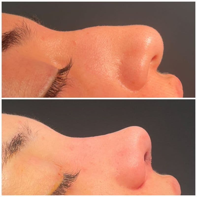 Rhinoplasty - Case 5 | Emirates European Hospital