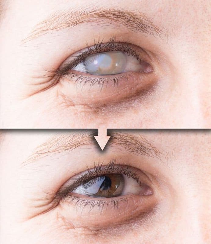 Cataract Surgery - Case 1 | Emirates European Hospital