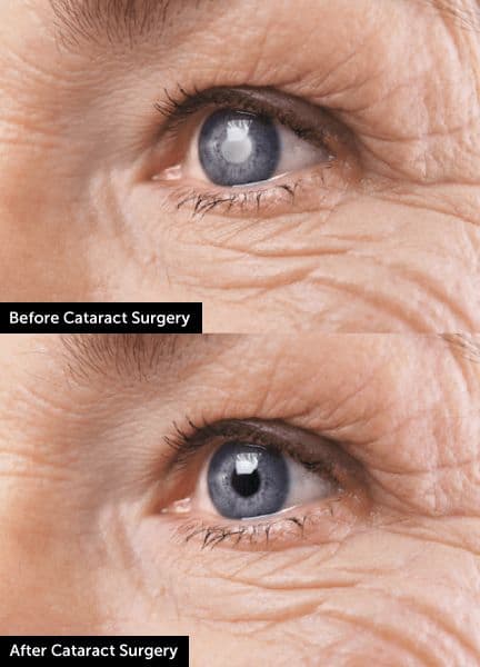 Cataract Surgery - Case 2 | Emirates European Hospital