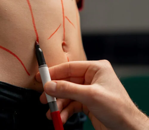 Best Liposuction in Sharjah