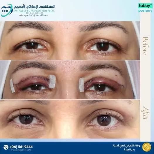 Eyelid Surgery - Case 1 | Emirates European Hospital