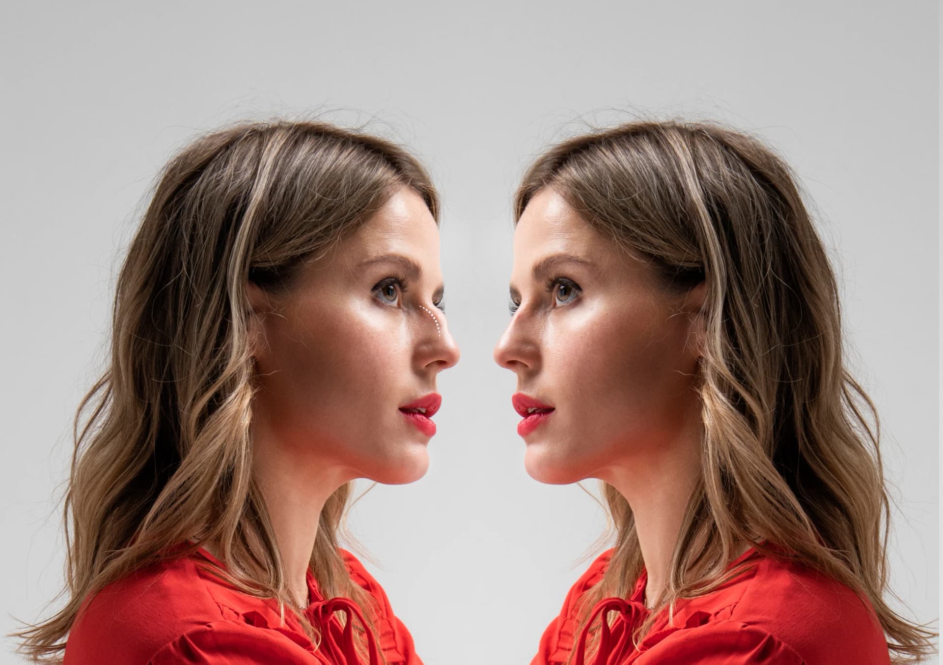 Rhinoplasty - Case 2 | Emirates European Hospital